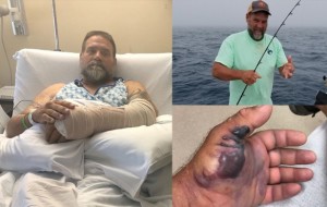 Flesh-eating bacteria infects man fishing off the coast of Florida